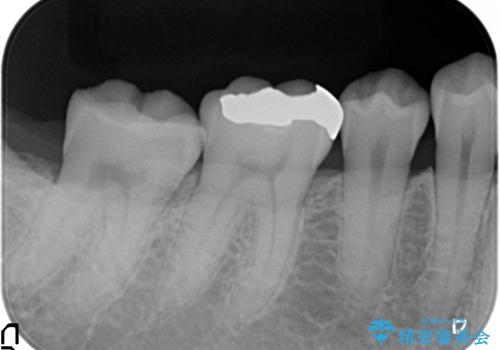 セラミックインレー 銀歯を白くの治療前