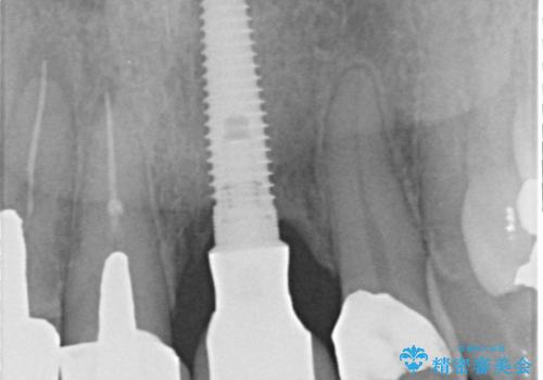 不良インプラントの除去・骨造成・歯肉移植・前歯審美セラミックブリッジ製作の治療前