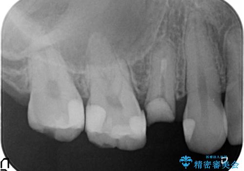 オールセラミッククラウン 根管治療 奥歯の補綴の治療前