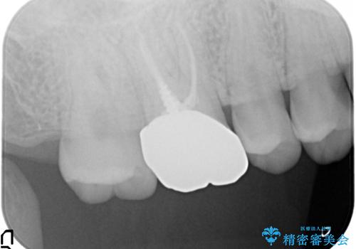 メタルボンドクラウン ゴールドから白い歯への治療前