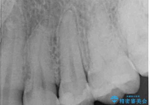 他院で治療中の歯 ゴールドインレーによる修復治療の治療前