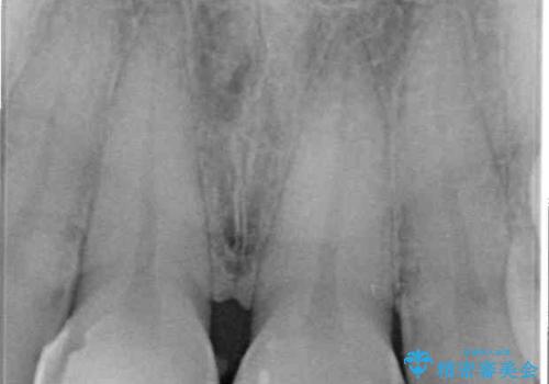 継ぎ接ぎだらけで歯肉も腫れてしまった前歯　オールセラミックの審美歯科治療の治療前