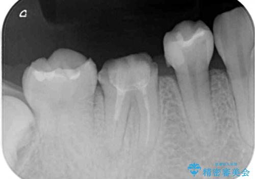 治療の度に痛んだ歯 セラミッククラウンによる補綴治療の治療前