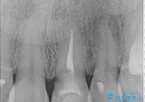 変色した前歯が気になる オールセラミッククラウンの治療前