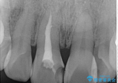 前歯の変色 セラミック審美補綴の治療前