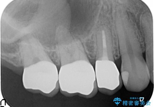 オールセラミッククラウン 根管治療 奥歯の補綴の治療後