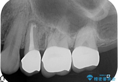 オールセラミッククラウン 根管治療後の補綴の治療後