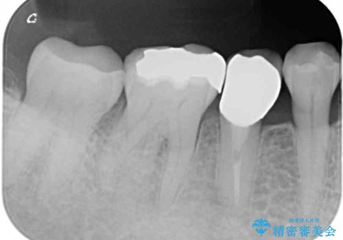 歯に穴があいた　奥歯のセラミック治療の治療後