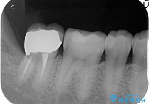 奥歯に違和感がある 30代男性の治療後