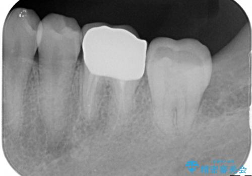 銀歯を白くしたい セラミッククラウンの治療後