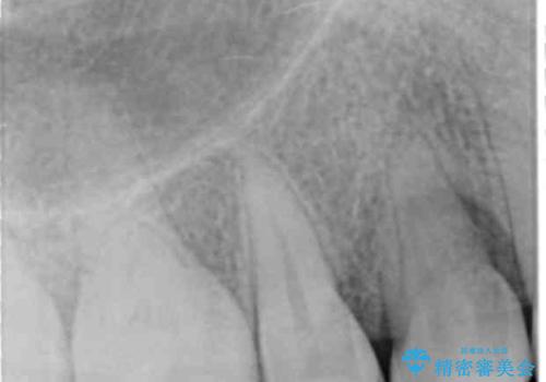 前歯のすきま 右上の小臼歯の垂直的骨吸収を抜歯で解決の治療前