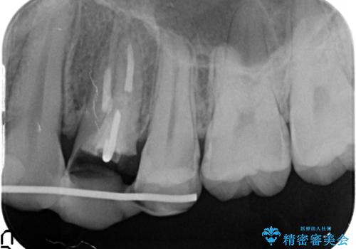 オールセラミッククラウン 歯牙の挺出後の補綴の治療中