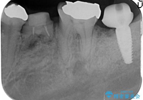 歯の破折による抜歯 インプラントによる咬合機能回復の治療中