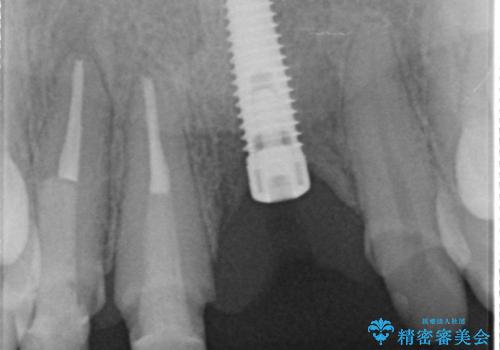 不良インプラントの除去・骨造成・歯肉移植・前歯審美セラミックブリッジ製作の治療後