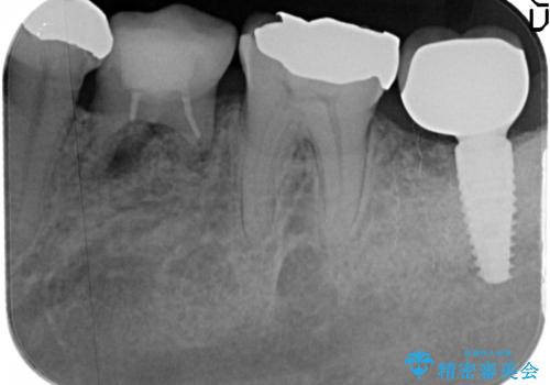 歯の破折による抜歯　インプラントによる咬合機能回復の治療後