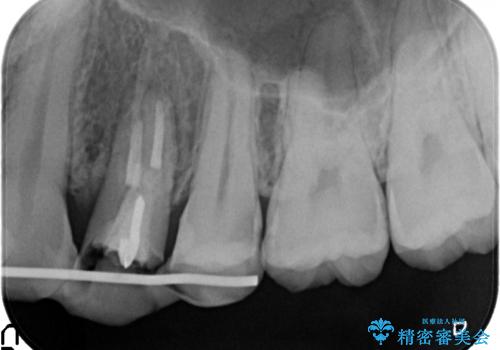 オールセラミッククラウン 歯牙の挺出後の補綴の治療中