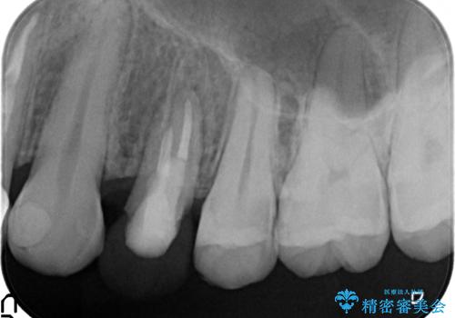 オールセラミッククラウン 歯牙の挺出後の補綴の治療中