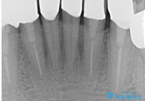 オールセラミッククラウン 前歯部の見た目の改善の治療後