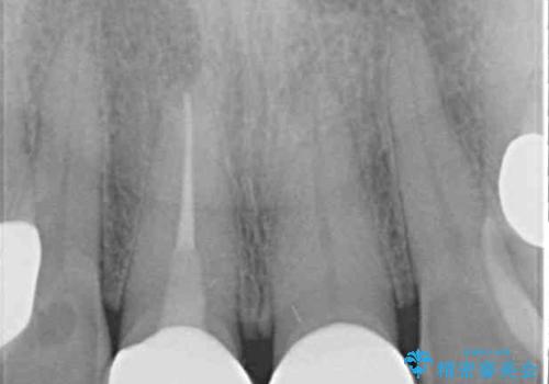 不調和な前歯の審美歯科治療の治療後