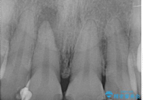オールセラミッククラウン(スペシャル) 変色が気になる前歯部の補綴の治療前
