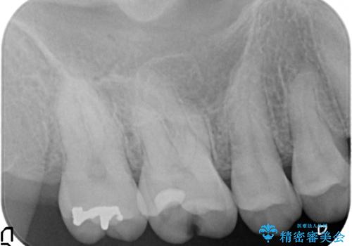 セラミックインレー　古い銀歯のやり替えの治療前