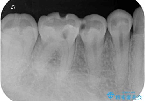 他院で治療中の歯 ゴールドインレーによる修復治療の治療前