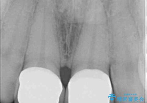 継ぎ接ぎだらけで歯肉も腫れてしまった前歯　オールセラミックの審美歯科治療の治療後