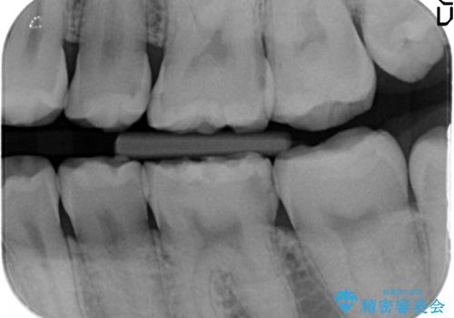 セラミックインレー 虫歯治療の治療前