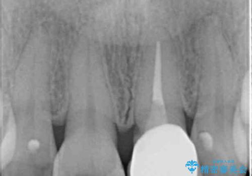 変色した前歯が気になる オールセラミッククラウンの治療後