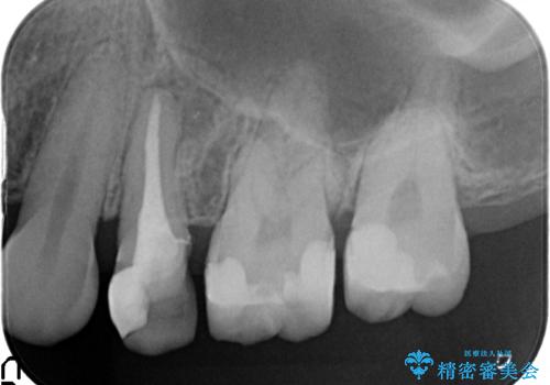 オールセラミッククラウン 根管治療後の補綴の治療前