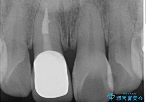 前歯の変色 セラミック審美補綴の治療後