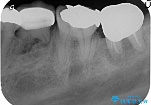 歯の破折による抜歯　インプラントによる咬合機能回復の治療前