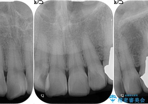 オールセラミッククラウン 前歯部の見た目の改善の治療前