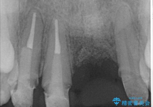 不良インプラントの除去・骨造成・歯肉移植・前歯審美セラミックブリッジ製作の治療中