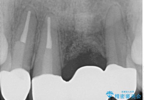 不良インプラントの除去・骨造成・歯肉移植・前歯審美セラミックブリッジ製作の治療後