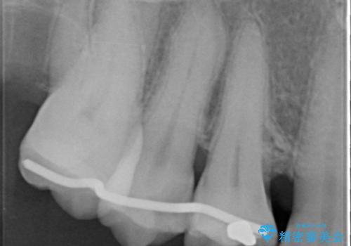 部分矯正を含む 歯周病治療 (再生治療・歯周ポケット除去・MTM・連結補綴)の治療後