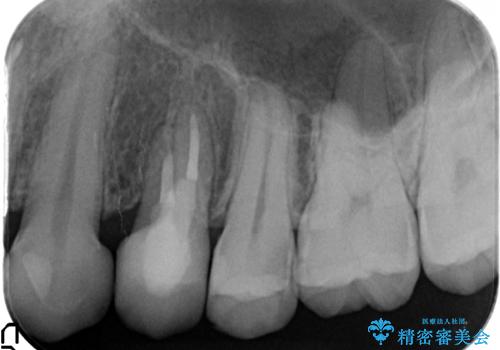 オールセラミッククラウン 歯牙の挺出後の補綴の治療後