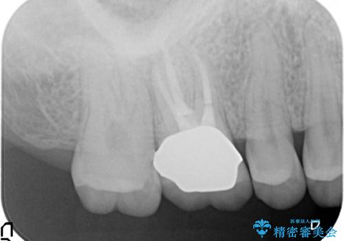 メタルボンドクラウン ゴールドから白い歯への治療後