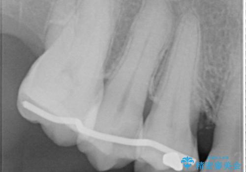 部分矯正を含む 歯周病治療 (再生治療・歯周ポケット除去・MTM・連結補綴)の治療後