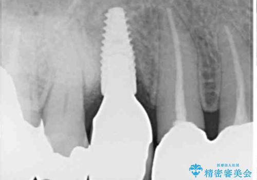 小臼歯の審美治療　ストローマンインプラントとカスタムアバットメントの治療後
