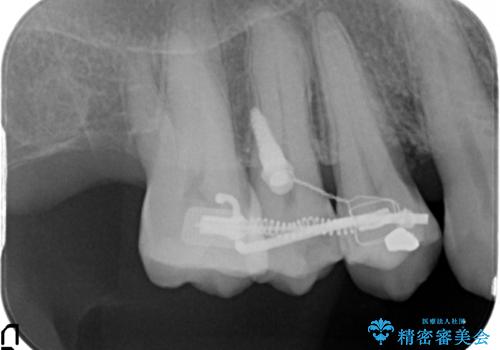 部分矯正を含む　歯周病治療 (再生治療・歯周ポケット除去・MTM・連結補綴)の治療後