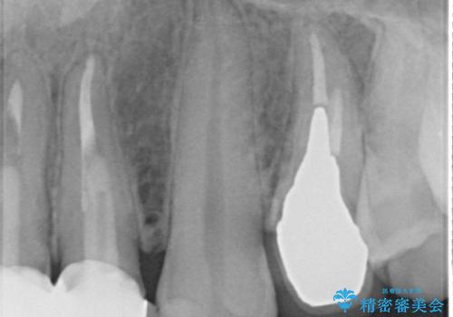 オールセラミッククラウン 歯牙の挺出後の補綴の治療前