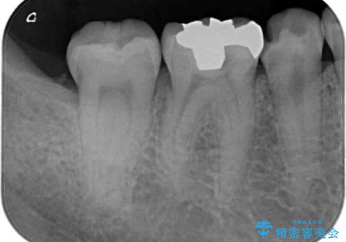 他院で治療中の歯 ゴールドインレーによる修復治療の治療後