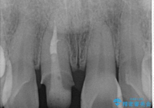 前歯の変色 セラミック審美補綴の治療中