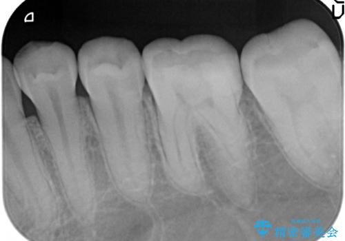 セラミックインレー 虫歯治療の治療後