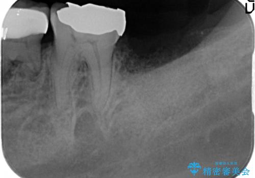 歯の破折による抜歯 インプラントによる咬合機能回復の治療後