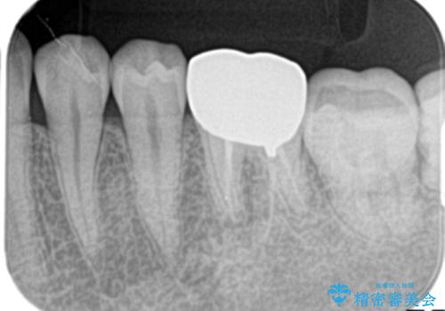 銀歯を白くしたい セラミッククラウンの治療前