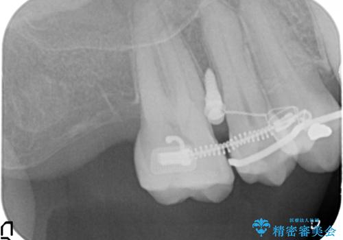 部分矯正を含む 歯周病治療 (再生治療・歯周ポケット除去・MTM・連結補綴)の治療後
