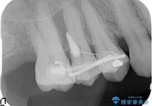 部分矯正を含む 歯周病治療 (再生治療・歯周ポケット除去・MTM・連結補綴)の治療後