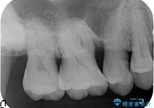 [歯周病治療]　再生療法　歯肉弁根尖側移動術の治療後